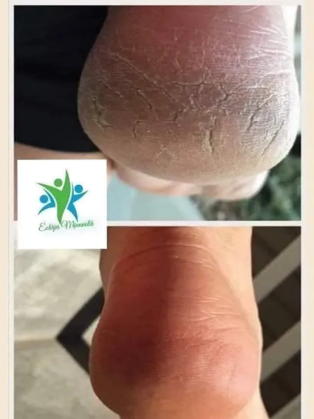 Scapă de ciuperca unghiei sau bătături cu produse bio fiecare utilizare zilnică îți voi explica produse se trimit ramburs în 3zile lucrătoare prin curier – fotografia 4 din 4